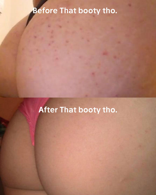 That Booty Tho for Butt Acne