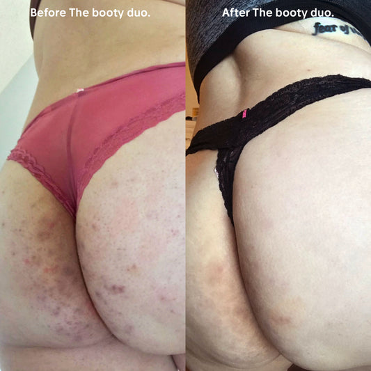 Booty Duo for Hyperpigmentation