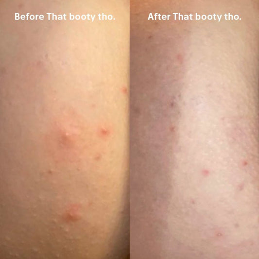 That Booty Tho for Butt Breakouts - Anese