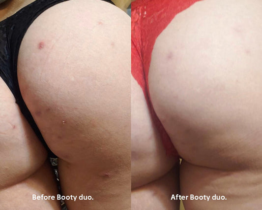 The Booty Duo for Butt Pimples - Anese